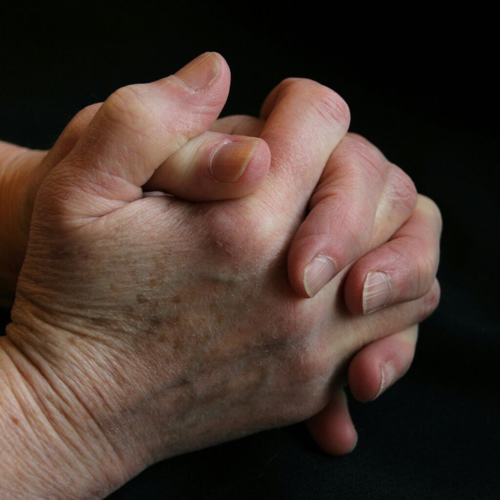 What Are the 4 Stages of Rheumatoid Arthritis? guide to symptom progression, inflammation, pain management, medical treatment, and joint health.