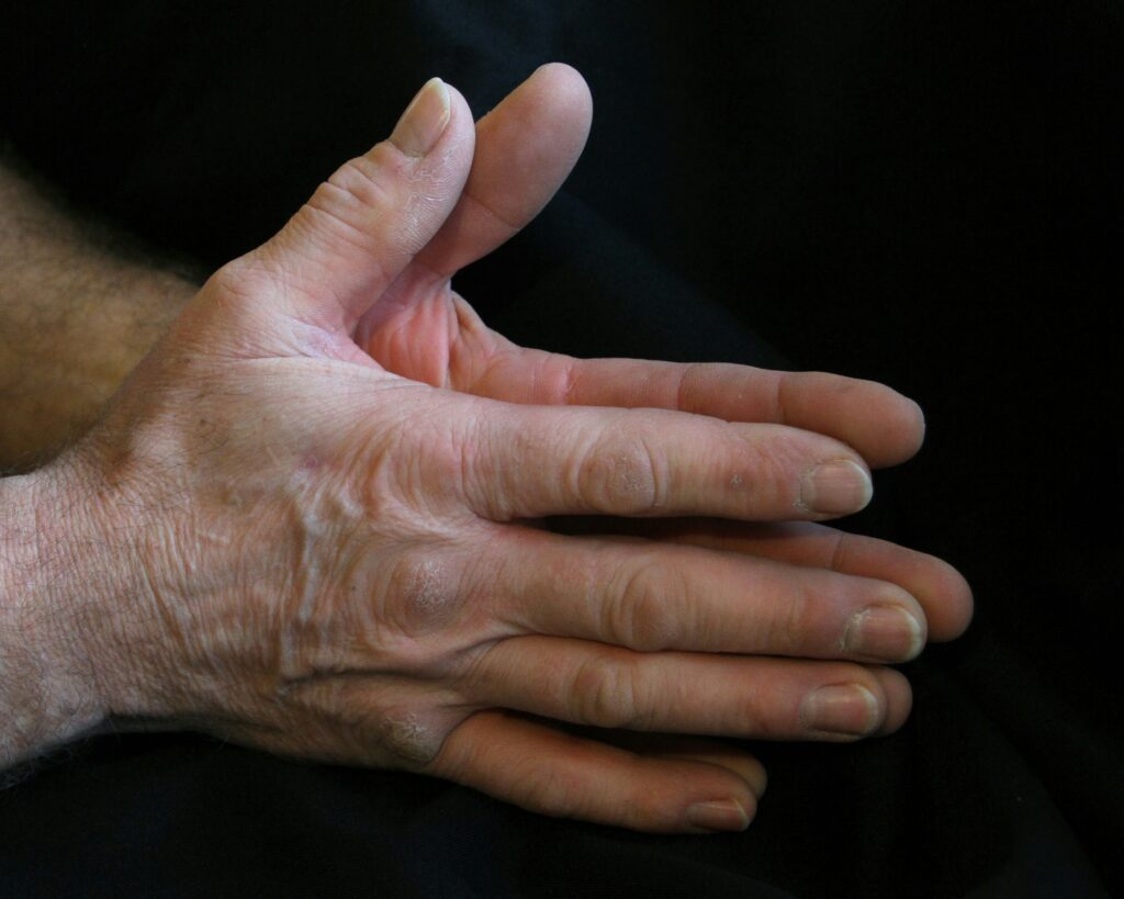 What Are the 4 Stages of Rheumatoid Arthritis? covering early diagnosis, disease progression, joint damage, medications, and long-term care.