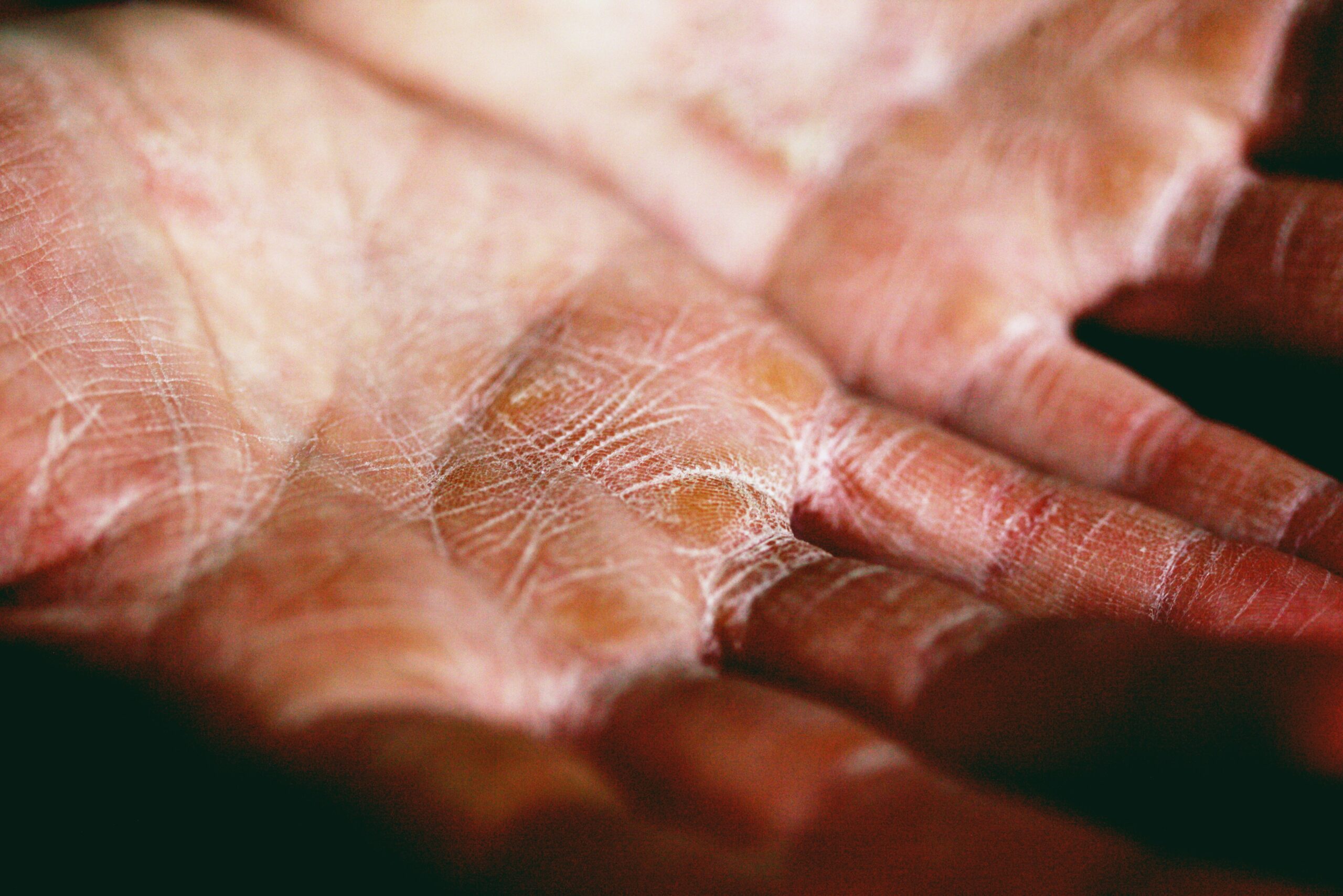 Why Is the Skin on My Hands Peeling? Causes, Symptoms, and Proven Solutions