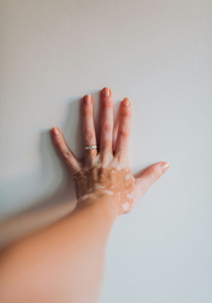 Why Is the Skin on My Hands Peeling? guide to peeling skin, dryness, allergies, irritation, eczema, infections, moisturizing, and skin protection.