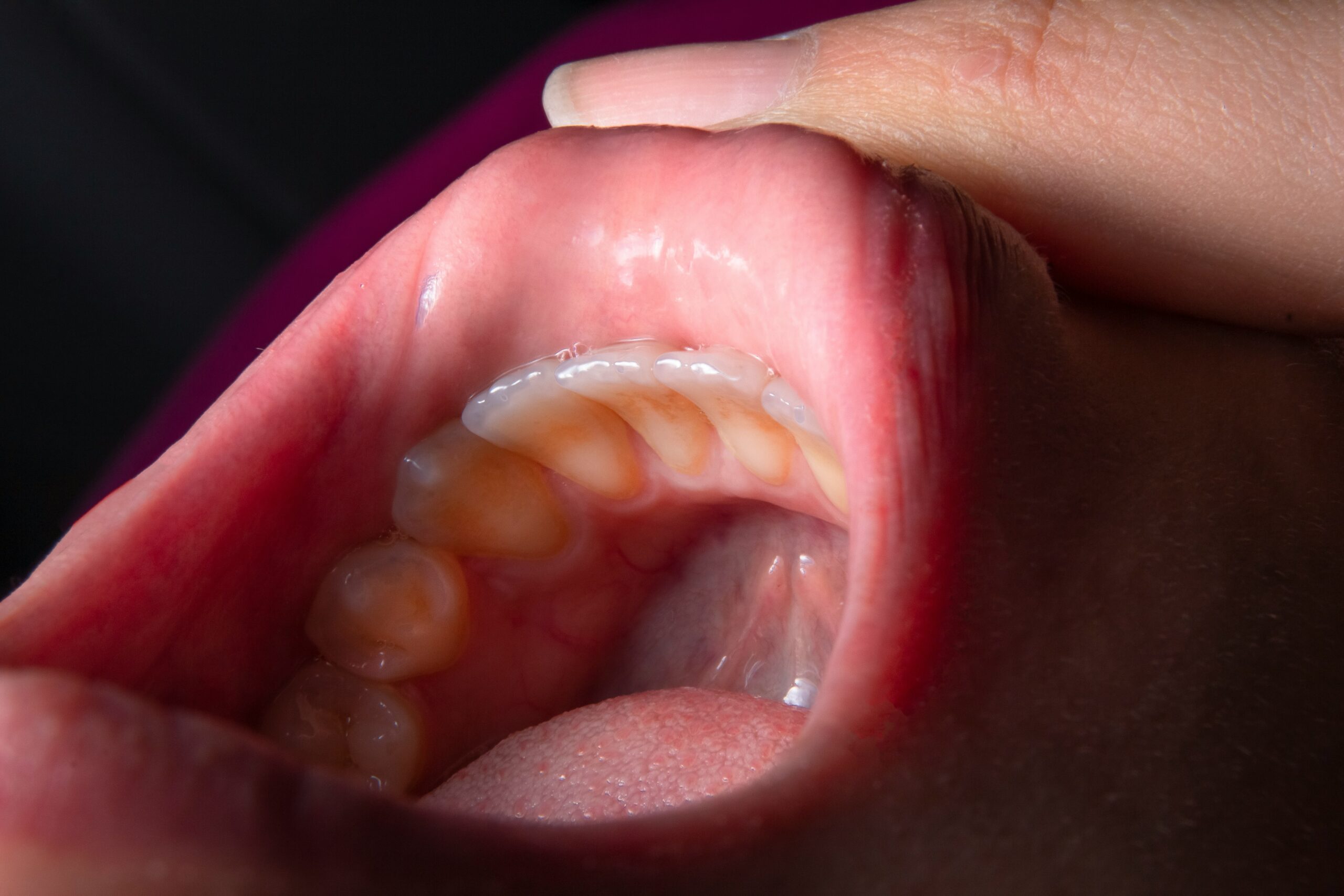 What Does Strep Throat Look Like? 7 Signs to Recognize It