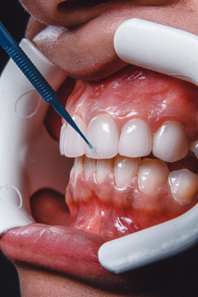 How to Remove Tartar From Teeth Without Dentist Visits featuring plaque control, brushing, flossing, oral hygiene, and tartar prevention tips.